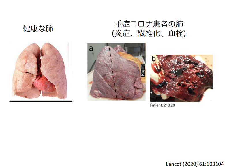 健康な肺と重症コロナ患者の肺(炎症、繊維化、血栓)